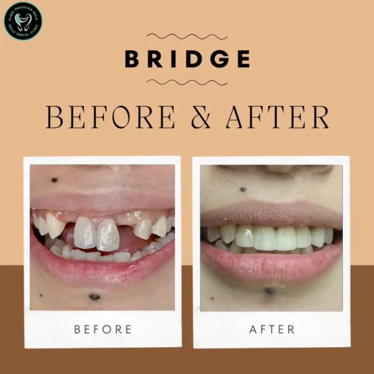 comparison bridge service - KP Melia
