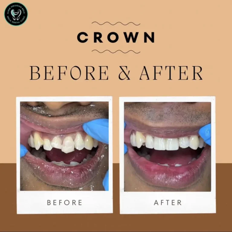 comparison crown service - KP Melia